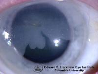 Translucent gray area of subtle conneal intraepithelial neoplasia involves 40% of the superior cornea.
